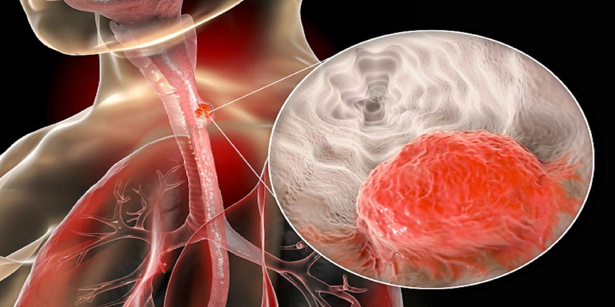 Groundbreaking Victory: Revolutionary Pill Poised to Vanquish Esophageal Cancer